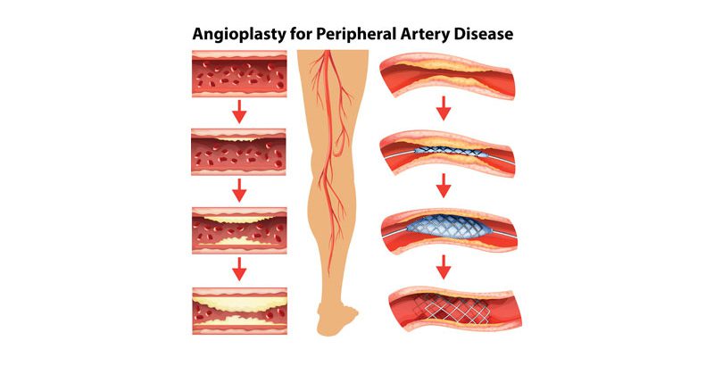 carolina-cardiology-associates-peripheral-artery-disease-pad