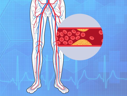 Peripheral Artery Disease